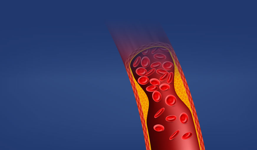 Profil lipidic (de bază)