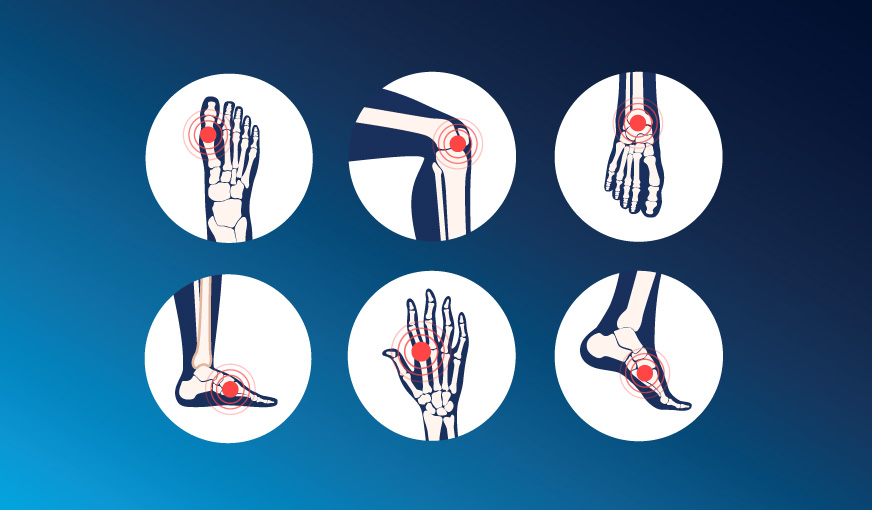 Probele reumatice, extins