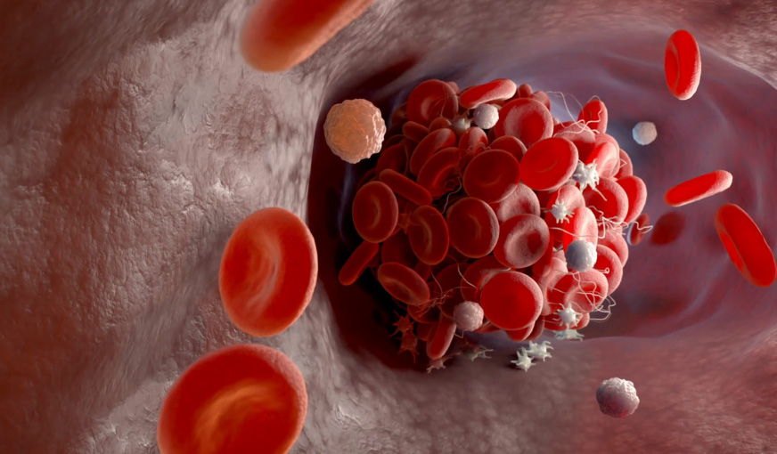 Profil antifosfolipidic (APS-de bază) 